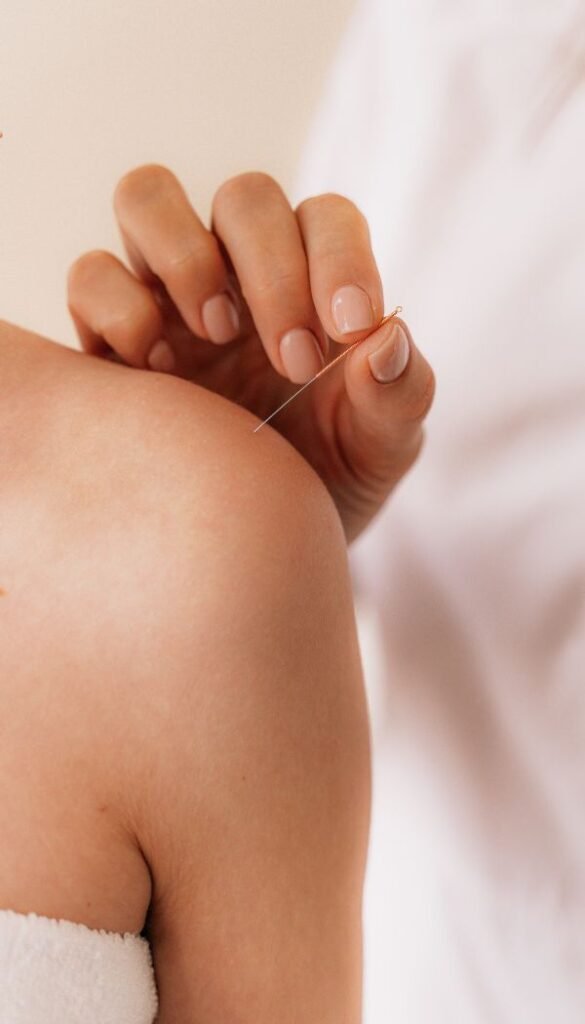 Acupuncture & Dry Needling