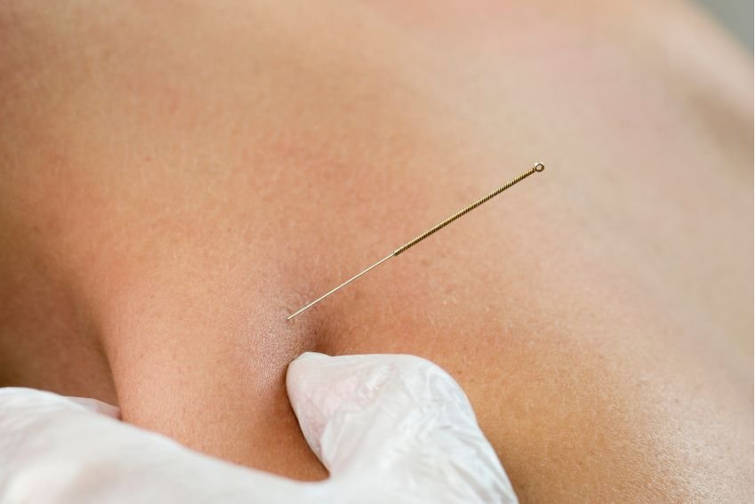 Acupuncture & Dry Needling