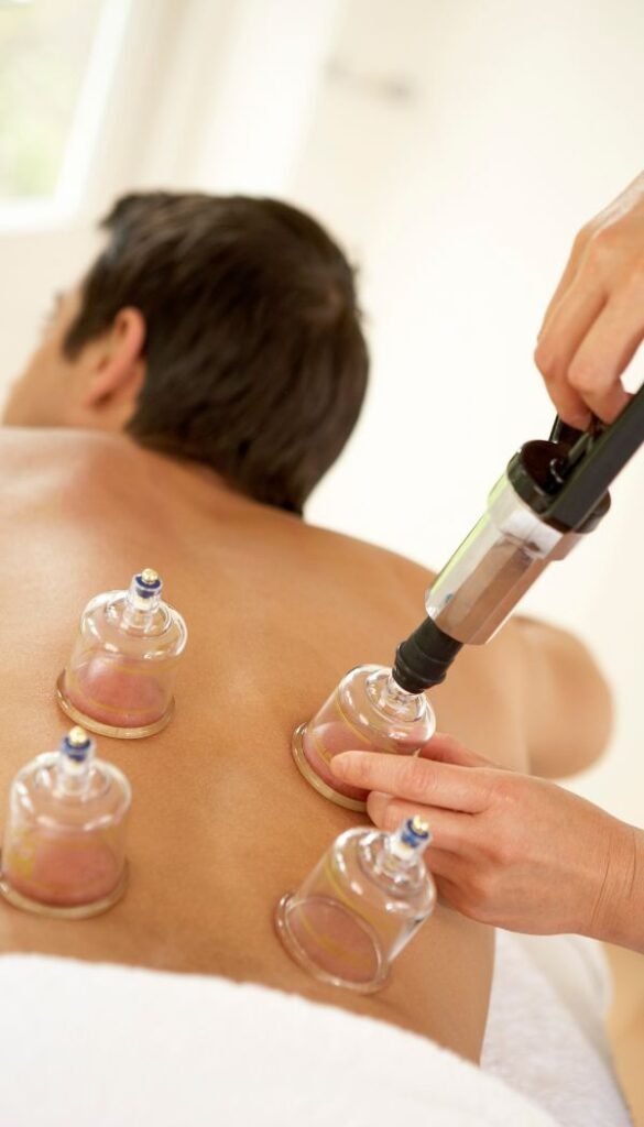 Cupping Therapy