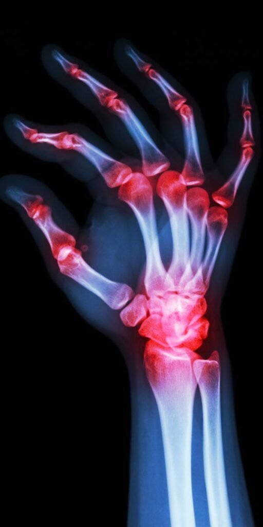 Arthritis