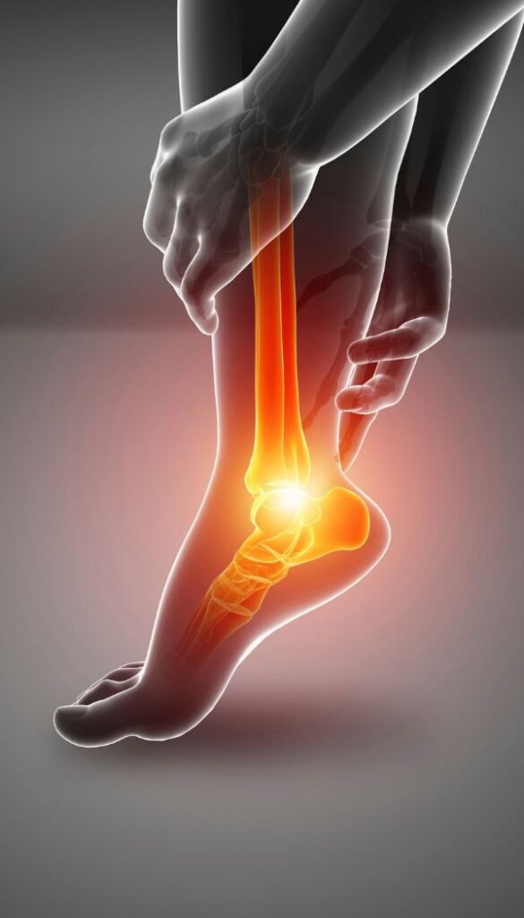 Plantar Fasciitis