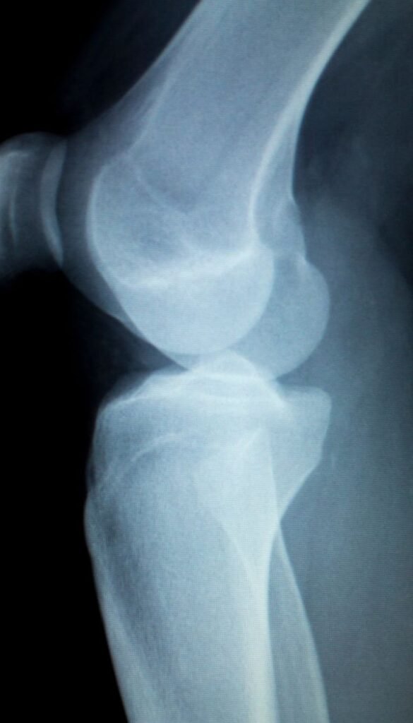 Labral Tears