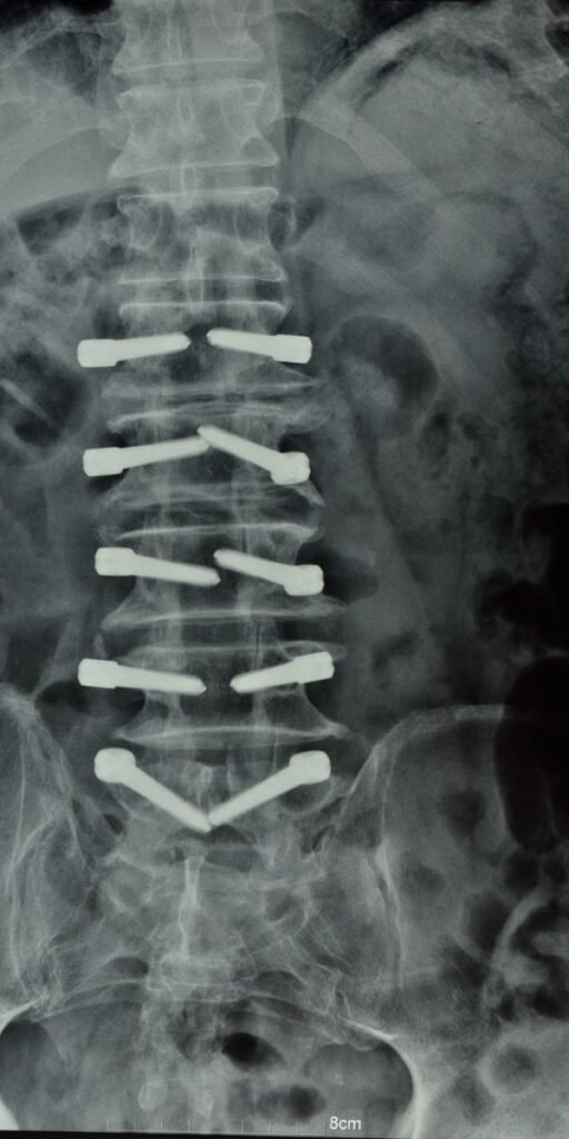 Prolapse