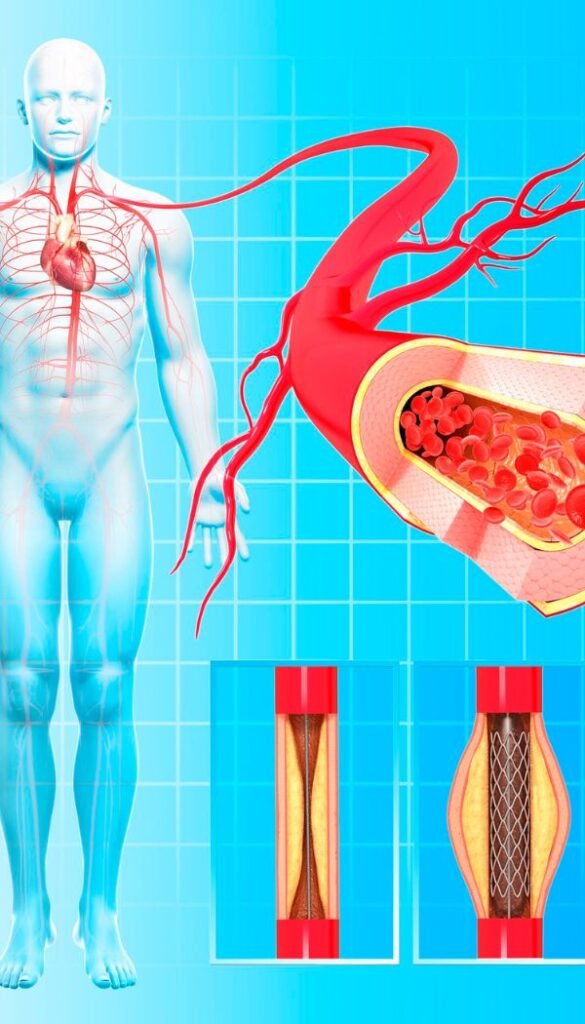 Percutaneous Coronary Intervention